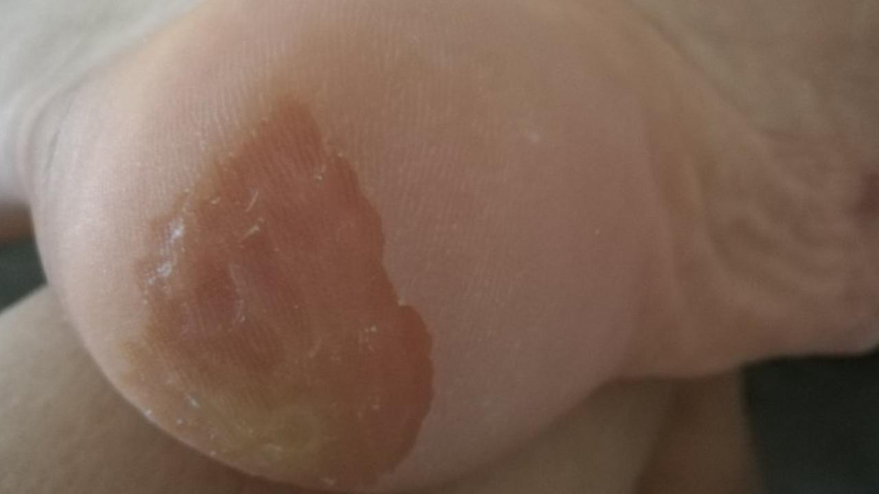 脚底板爱紫是什么原因,脚底板爱起皮是怎么回事