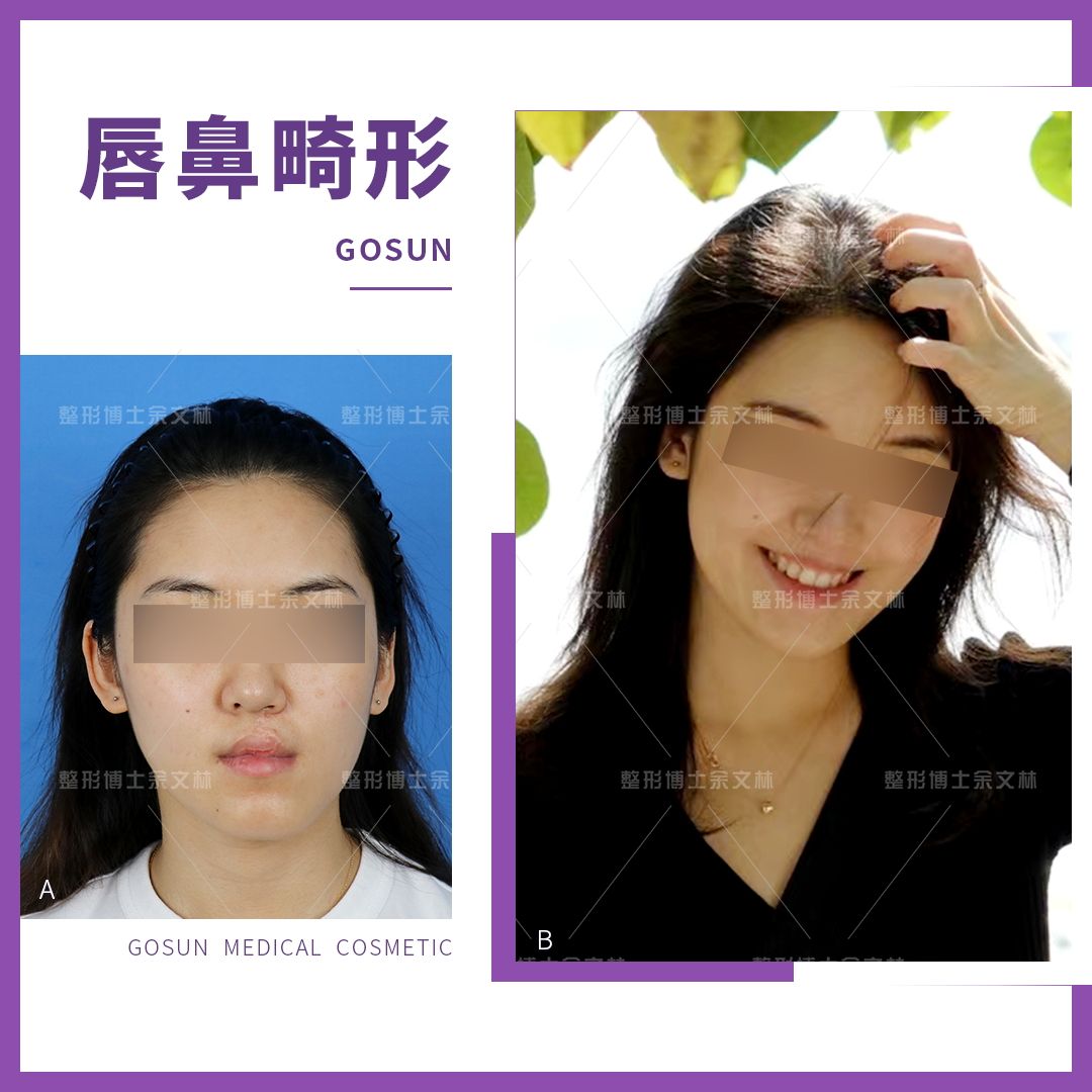 唇裂手术疤痕修复手术大概多少钱,唇裂手术后1个月后涂什么疤痕膏