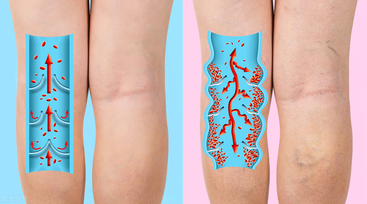 缓解静脉曲张有十招,治疗静脉曲张有什么土方法