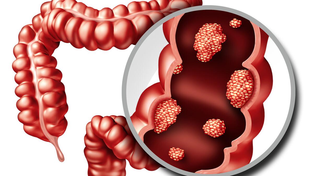拉肚子导致的痔疮可以自愈吗,腹泻为什么也会有痔疮