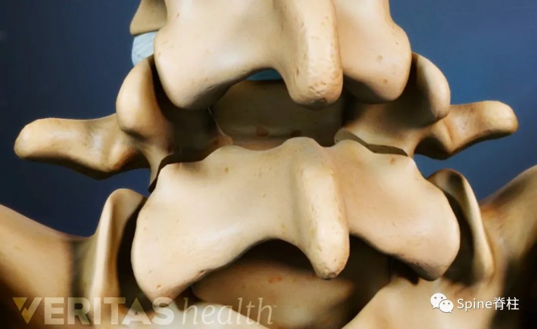 轻度峡部裂和重度峡部裂的区别,真性峡部裂和假性峡部裂