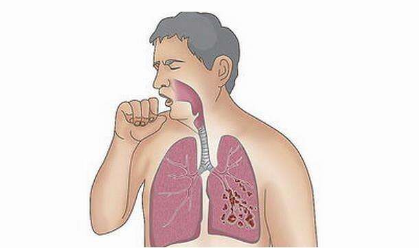 支气管扩张引起的咯血怎么治,支气管扩张为什么会咯血视频