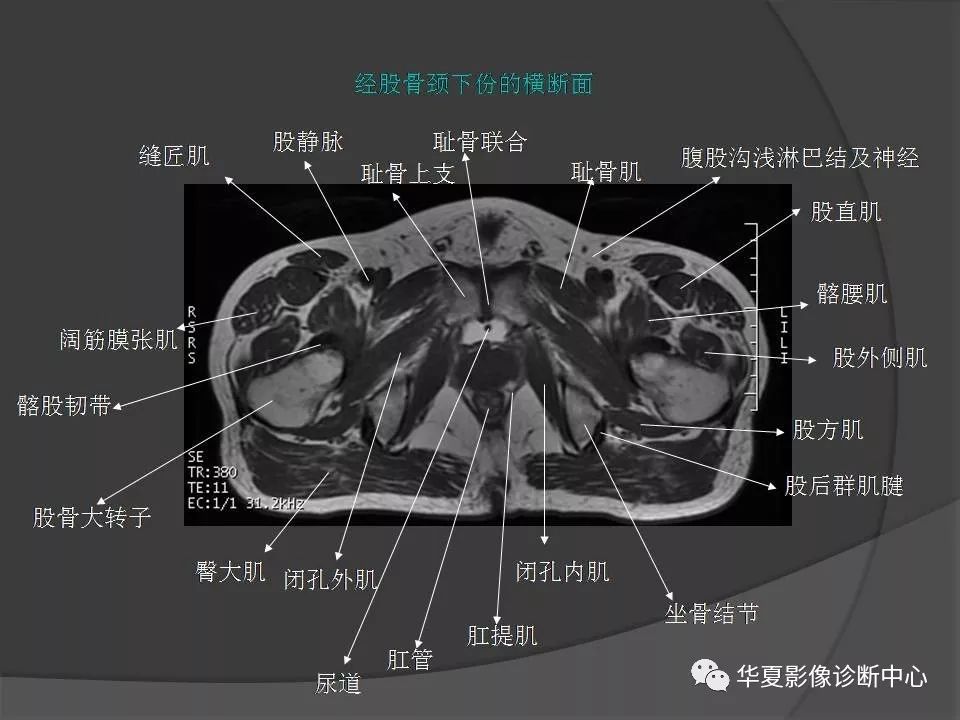 女性盆腔ct连续断层解剖图,盆腔mri影像病例分析