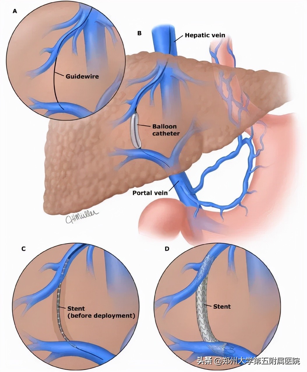 食管胃底静脉曲张破裂二次出血,胃底静脉曲张破裂出血致死