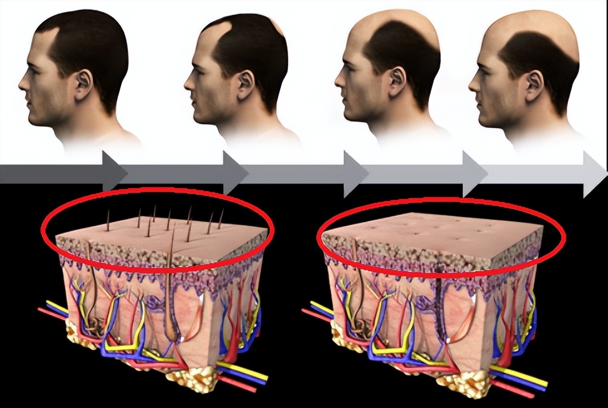 脱发很严重什么原因引起的,脱发是怎么引起的要注意什么