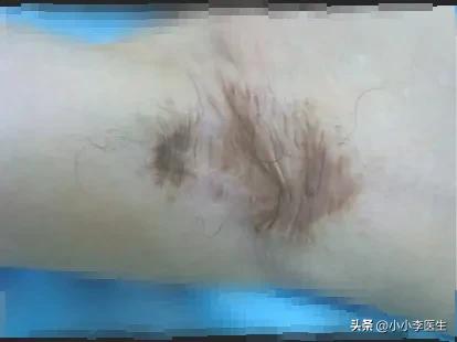 男生狐臭怎么才能彻底去除,怎么才能去除狐臭