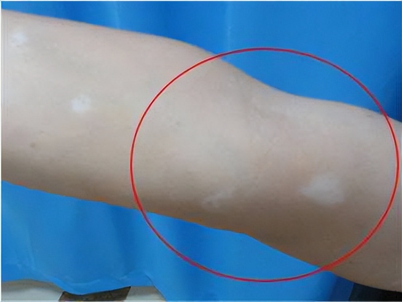 白癜风用药最多的是什么药,选择治疗白癜风方法谨记三大事项