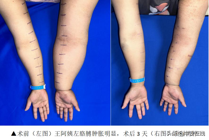 淋巴管堵塞下肢肿胀怎么办,淋巴管阻塞哪里治