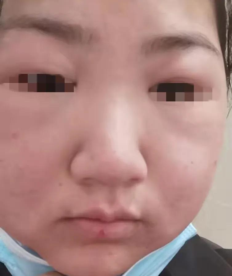 护肤小知识之过敏,过敏期间护肤的正确方法