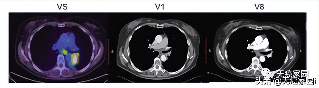 12年化疗失败，干细胞移植复发，CAR-NK疗法让癌症患者完全缓解