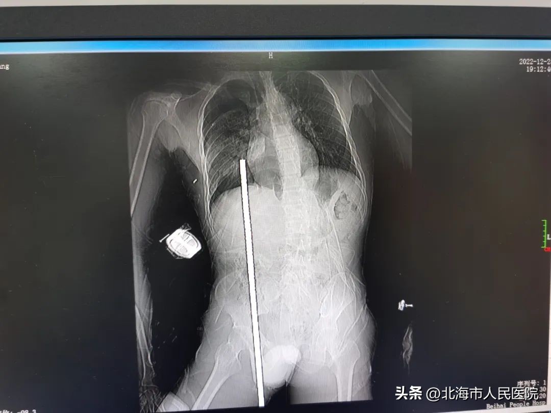 男子被十几根钢筋刺穿,北海一工人被钢筋刺穿