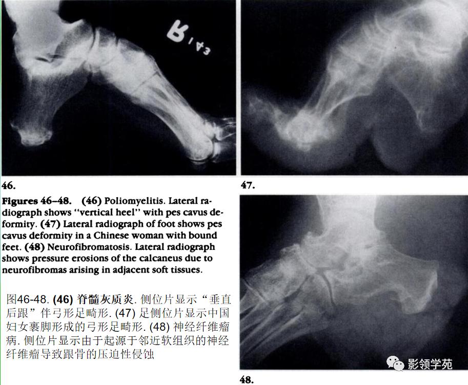 正常跟骨影像图,跟骨正常与变异影像表现图片