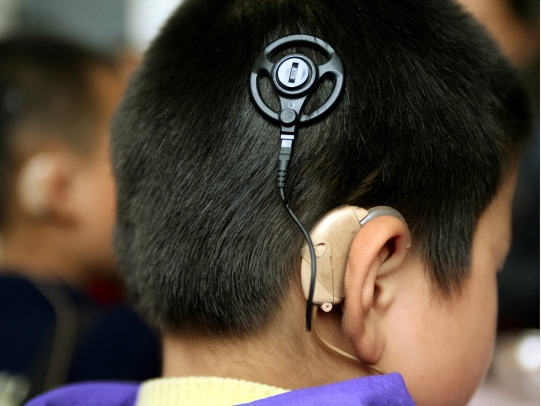 人工耳蜗进口的2023多少钱,国产人工耳蜗和进口差距