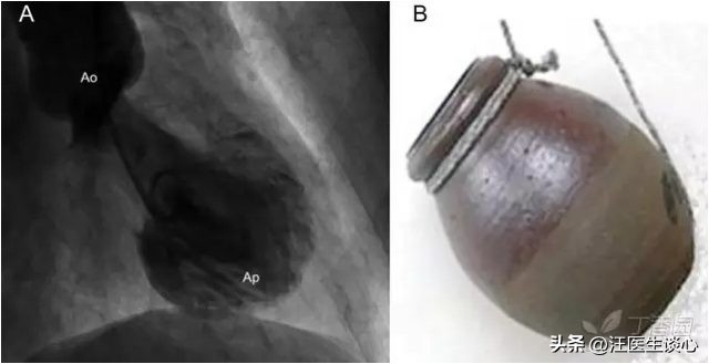 情绪激动也会“心碎”？