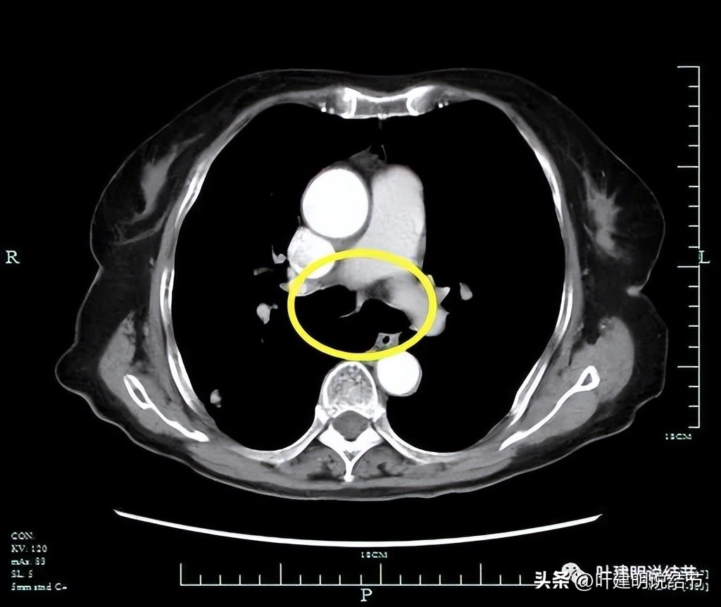 79岁肺癌早期手术风险,75岁早期浸润性肺癌还要治疗吗
