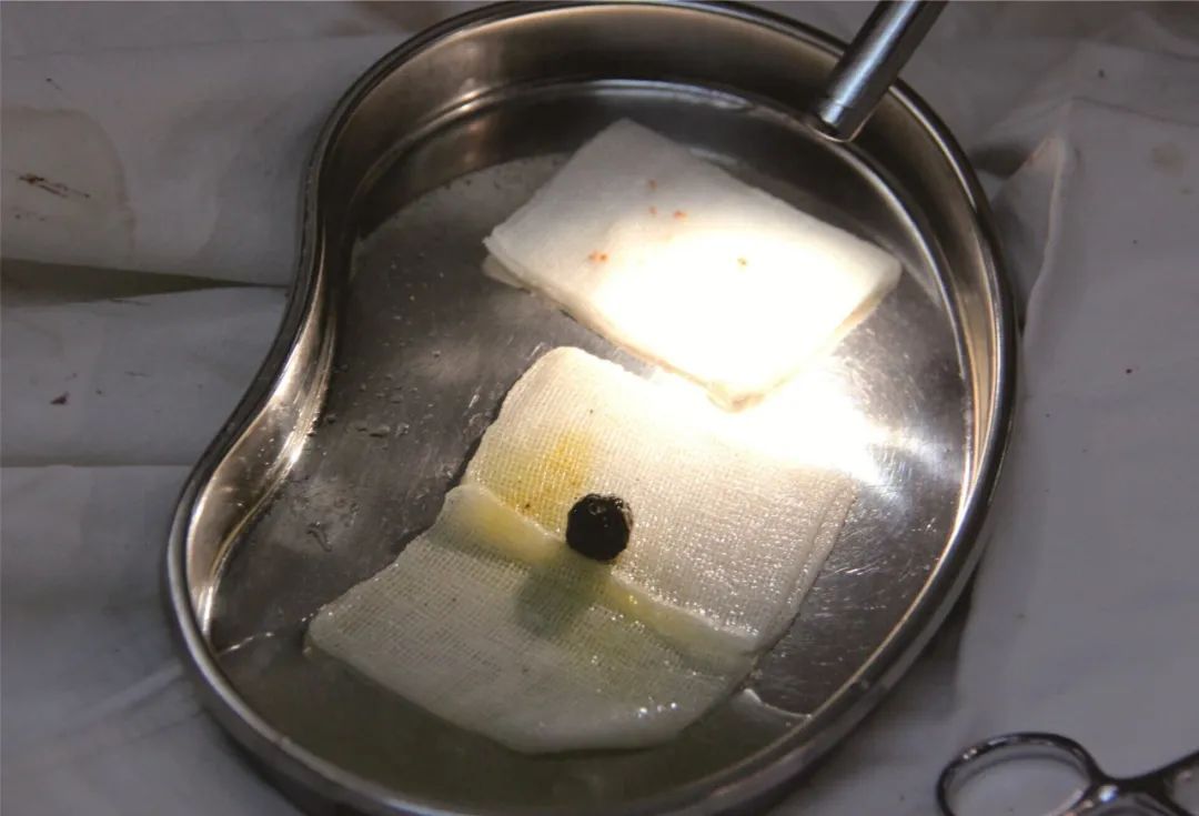 胆结石保胆取石哪家医院做的最好,四川胆结石医院排名