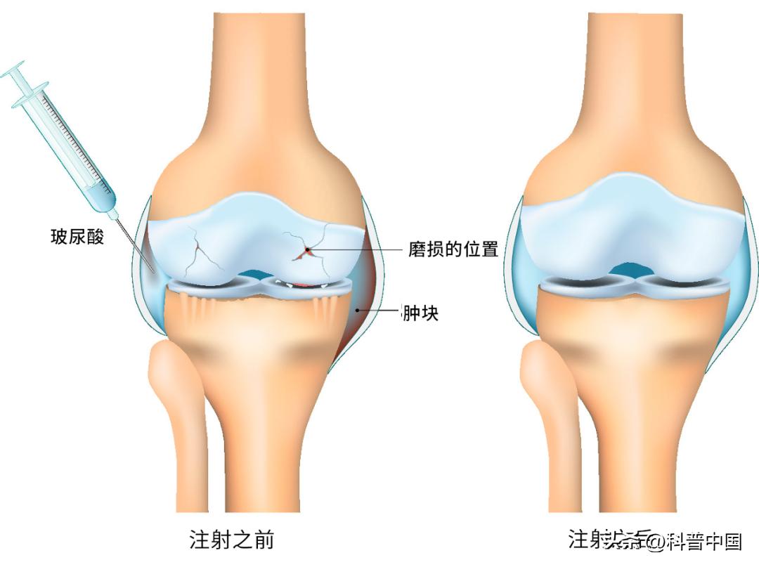 女子打水光针毁容了,打水光针毁容真实视频