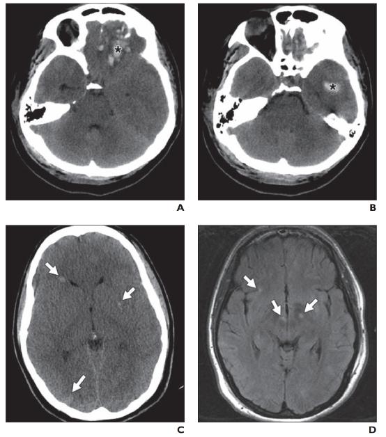 脑水肿的影像,脑水肿形成机制生理学