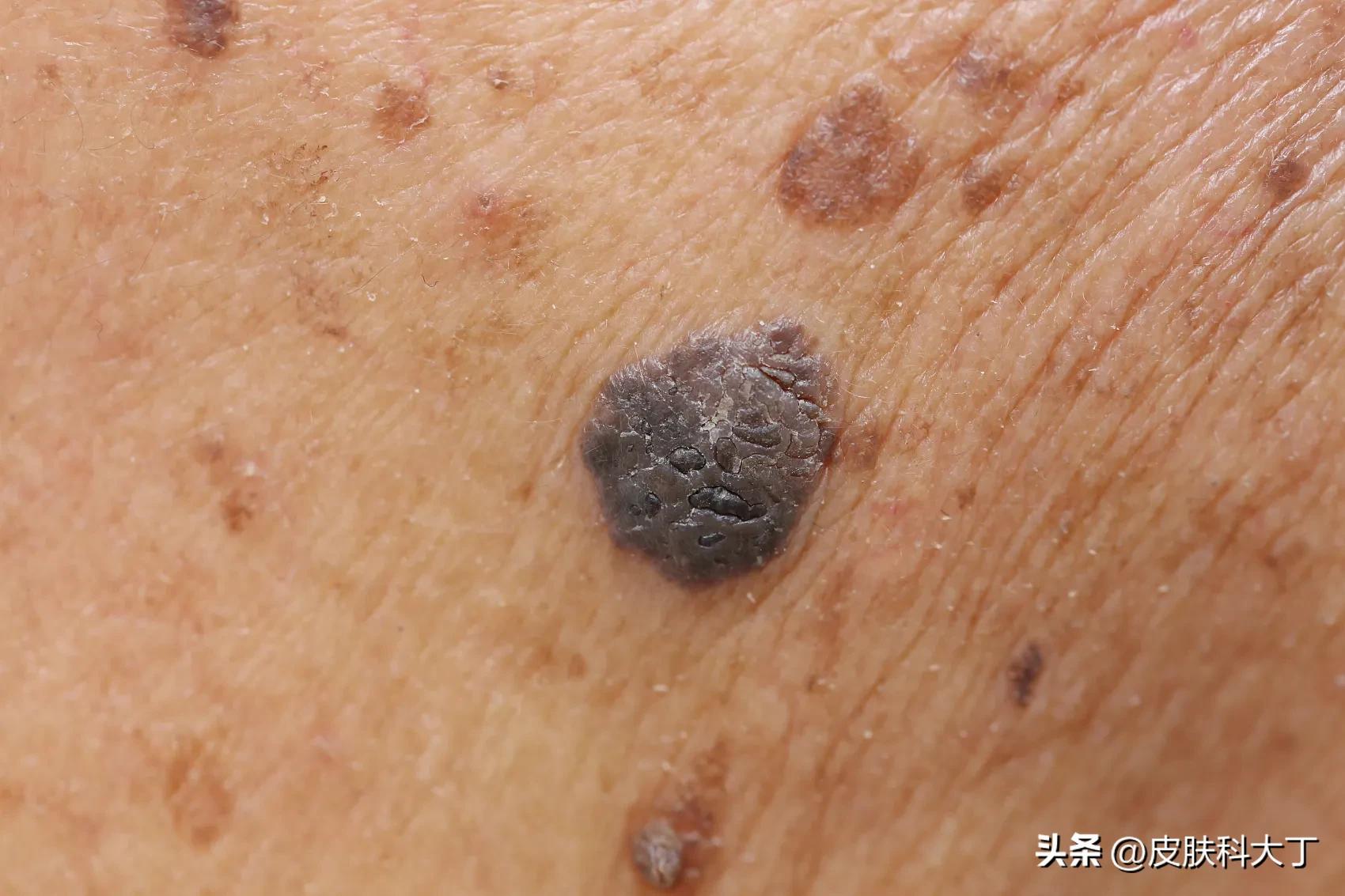 脸上老年斑和黑色素瘤有什么区别,脸上长黑色素斑慢慢就变成黑痣了