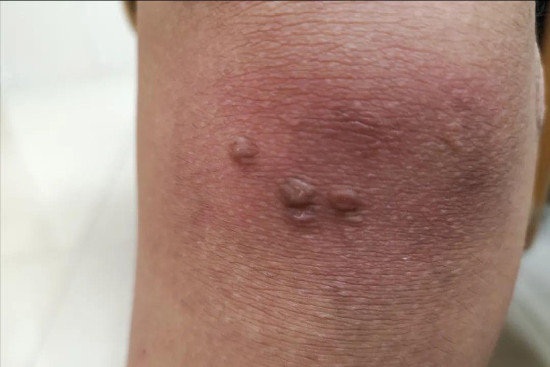 hpv和疣是一种病吗,hpv病毒疣是什么样的