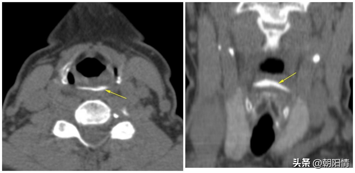 消化道异物中医诊断名称,消化道骨性异物