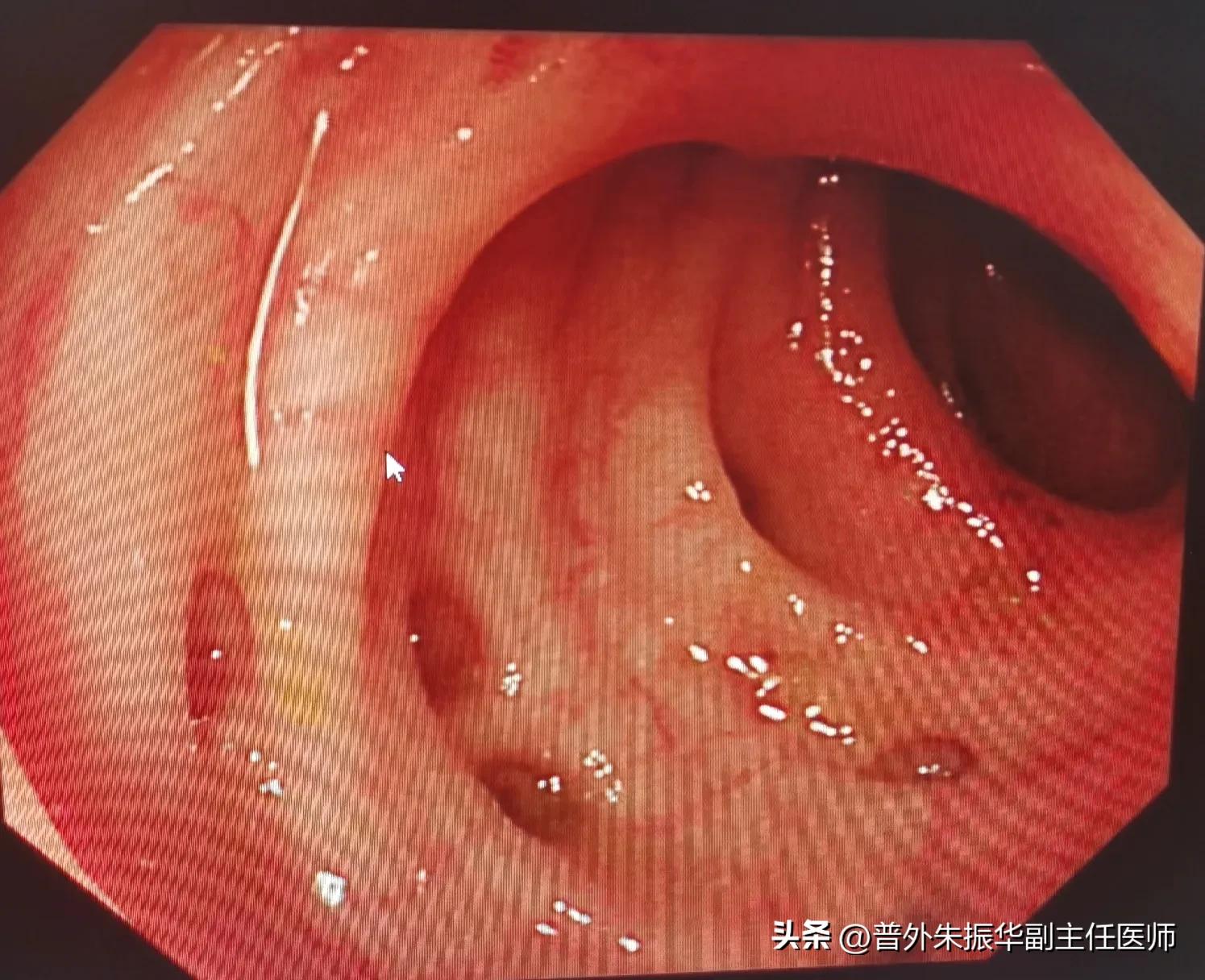 带您认识肠套叠是怎么回事？