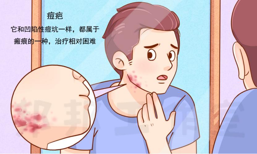 痘印全攻略——不同类型的治疗选择
