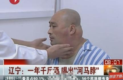 辽宁男子喝3万斤酒撑大脖子,男子嗜酒如命一天三四斤白酒