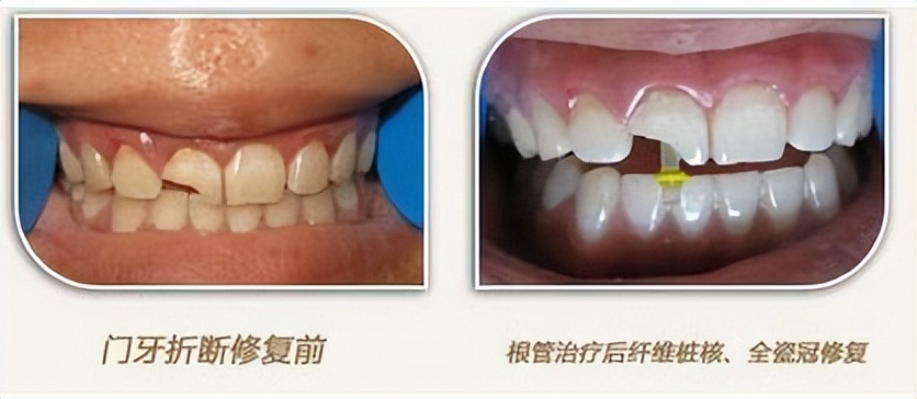 牙齿断了一半怎么处理最好多少钱,牙齿断了一半怕冰怎么处理最好