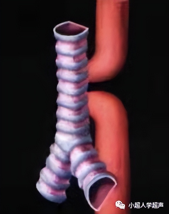 超声影像小视频,食道闭锁超声表现