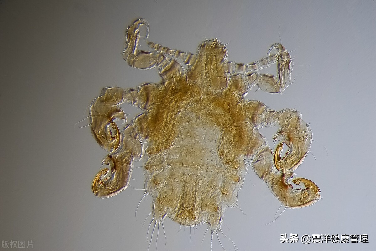 男子腹部痒，医生用镊子夹出16只阴虱！原来阴虱的传播途径有4个