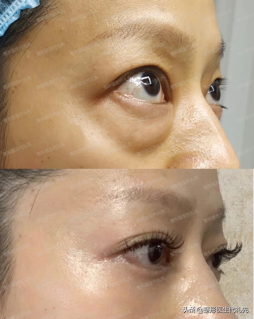 眼袋外切卧蚕留下卧蚕图片,眼袋和卧蚕有什么区别怎么祛眼袋