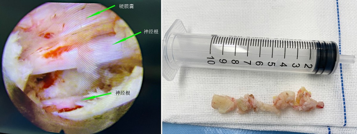椎间盘突出微创手术对脊椎的影响,颈椎间盘突出椎管狭窄微创手术