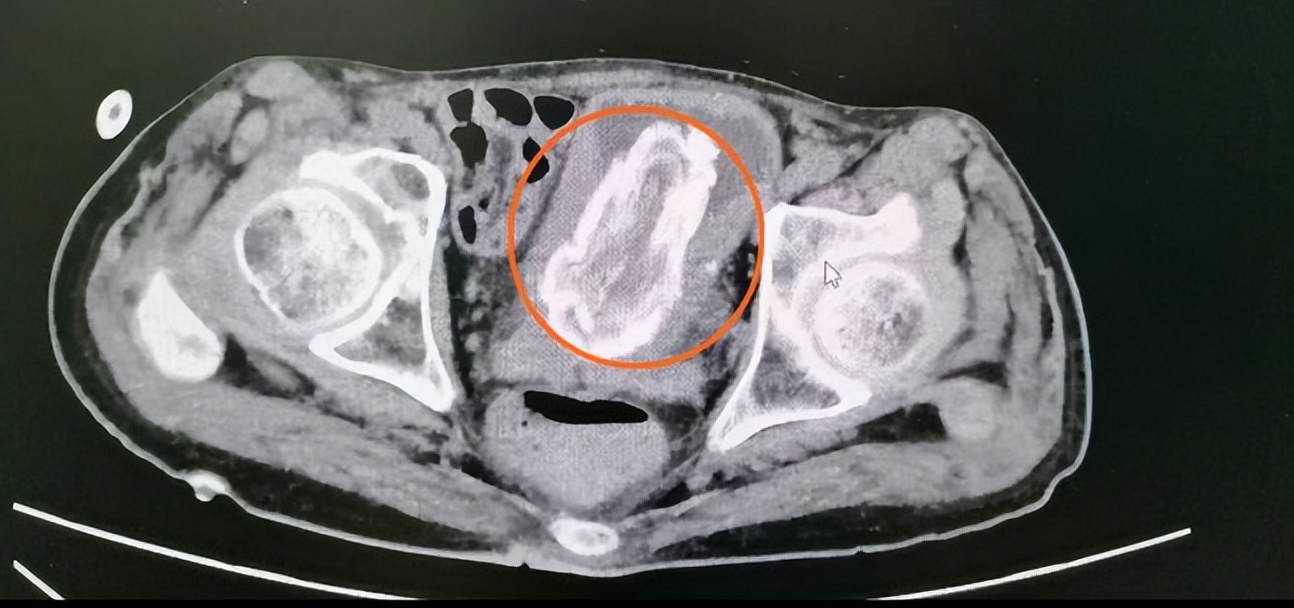 直肠内异物看病经验分享,直肠内壁异物