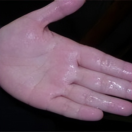 手经常出汗玩手机怎么办,经常手出汗