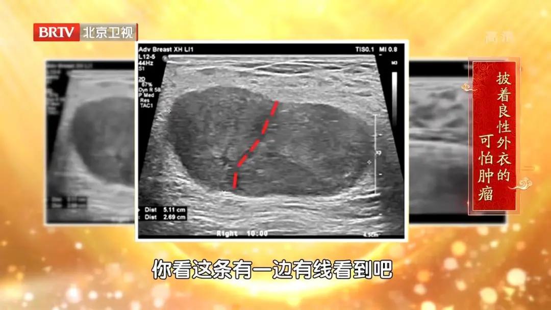 体检查出乳房长了肿瘤,乳房长了小肿瘤一级