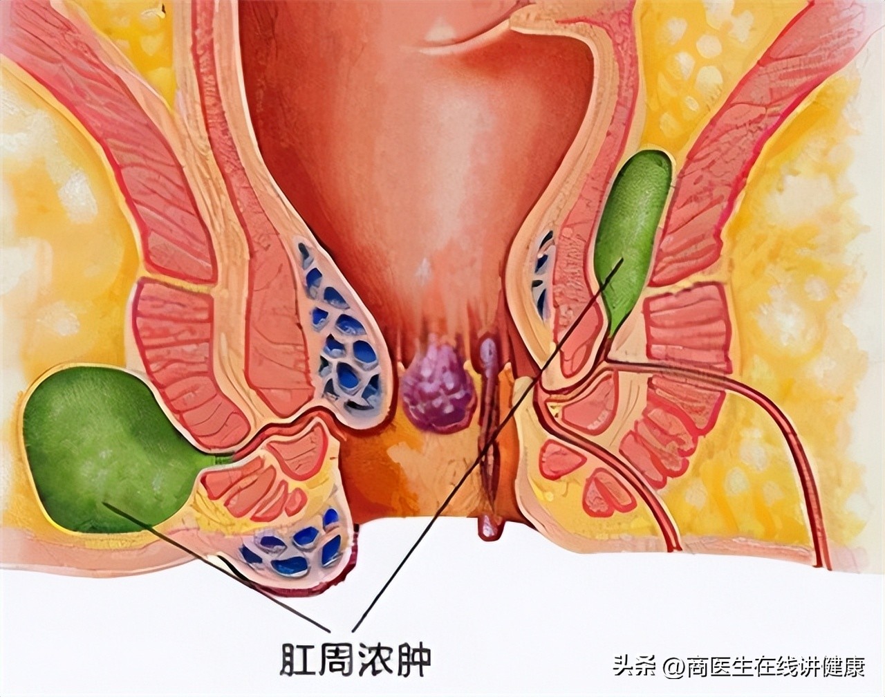 肛瘘手术快愈合了为什么有点痛,肛瘘引起脓肿不想手术