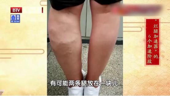 单腿小腿酸胀发麻是静脉曲张吗,腿酸胀难受怎么缓解静脉曲张