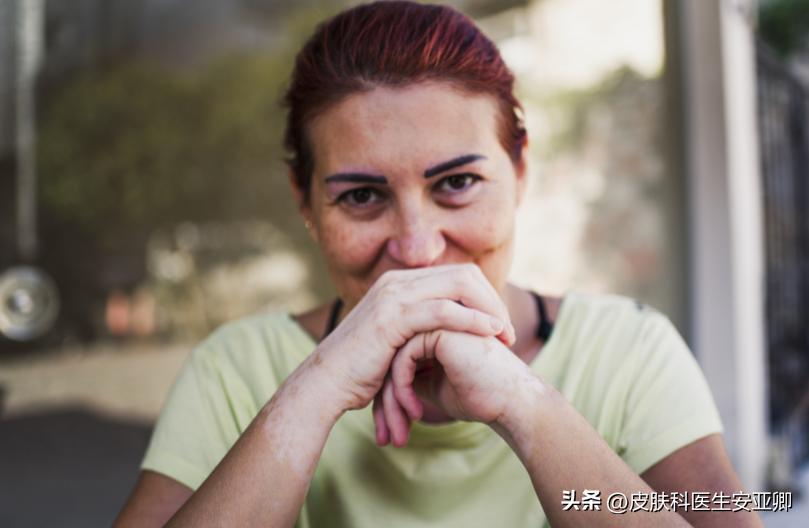 银屑病和白癜风用的光疗有区别吗,白癜风治疗308准分子光好使吗