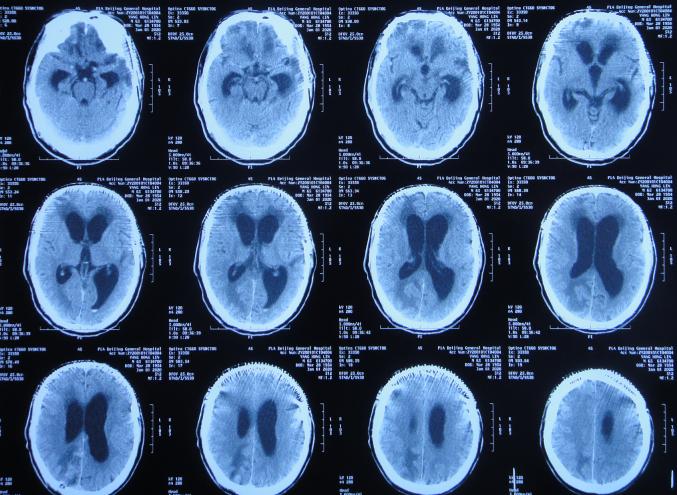 脑外伤后硬膜下积液颅骨修补,颅骨修复手术失败导致脑积水