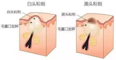 夏天额头突然密密麻麻小颗粒原因,宝宝额头长密密麻麻小颗粒怎么办