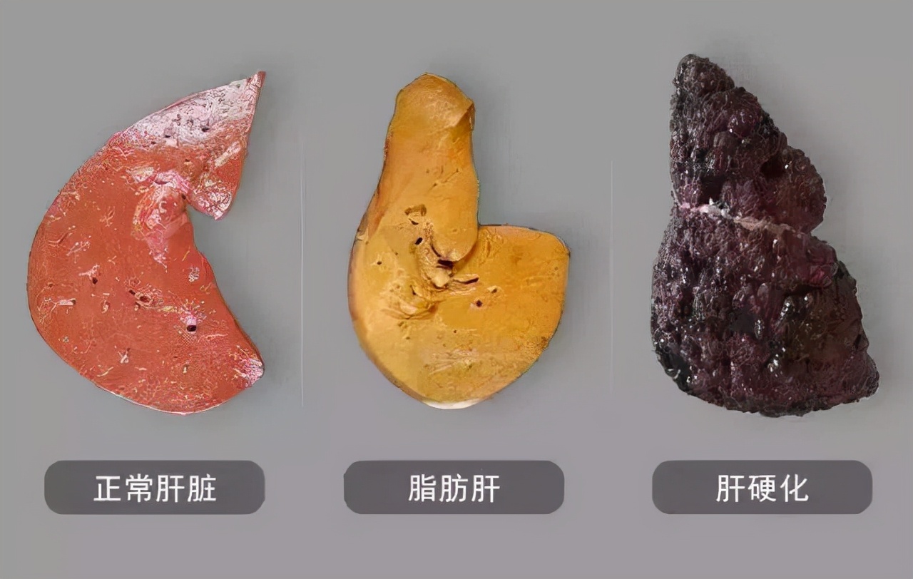 为什么医生建议停止使用绞肉机,使用绞肉机会损伤肝脏系谣言