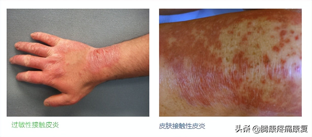 皮质类固醇贴剂治疗瘢痕疙瘩,类固醇激素治疗疤痕增生