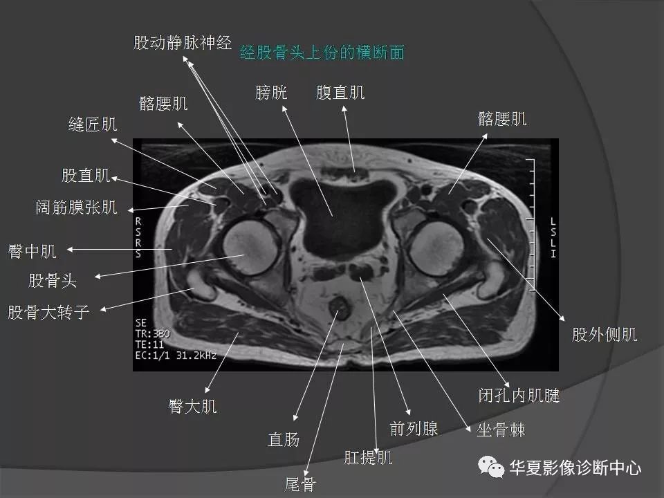 女性盆腔ct连续断层解剖图,盆腔mri影像病例分析