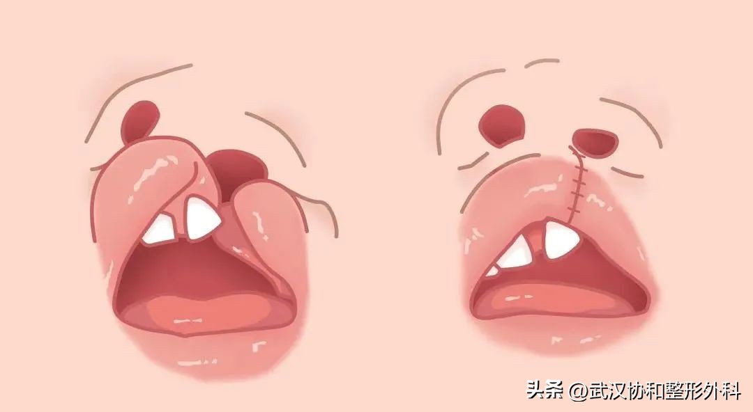 唇腭裂做一次手术就好了吗,唇腭裂一次性做完鼻子好吗
