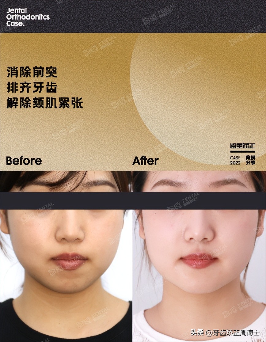 低角面型下巴前倾正畸案例,露龈笑嘴凸下巴后缩