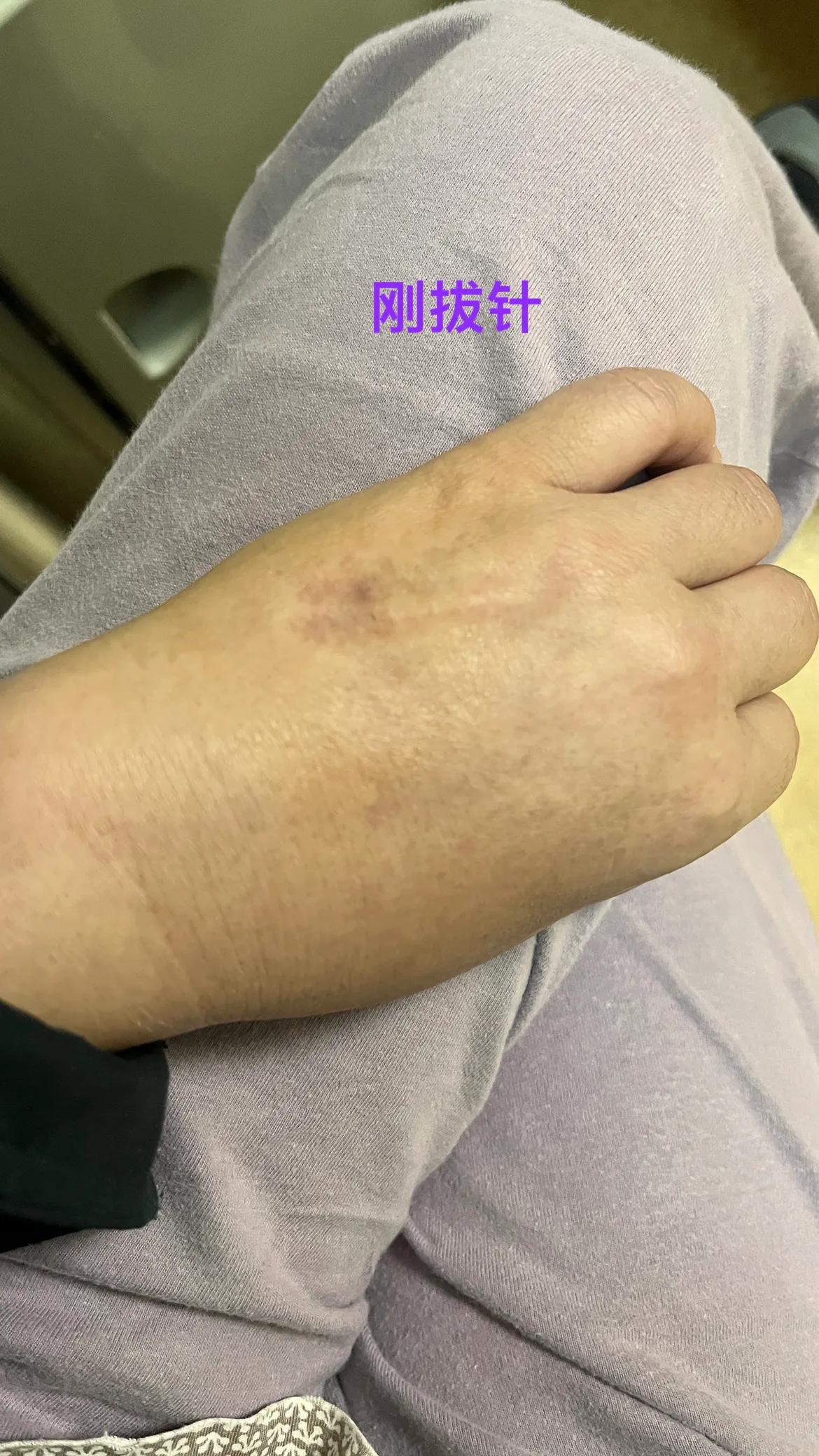 从早上不到十点打点滴到现在（晚八点）！本来是两瓶...