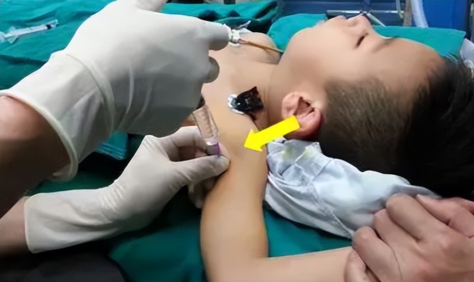 剖宫产手术，不同的全身麻醉方法有啥区别？对胎儿健康影响不同！