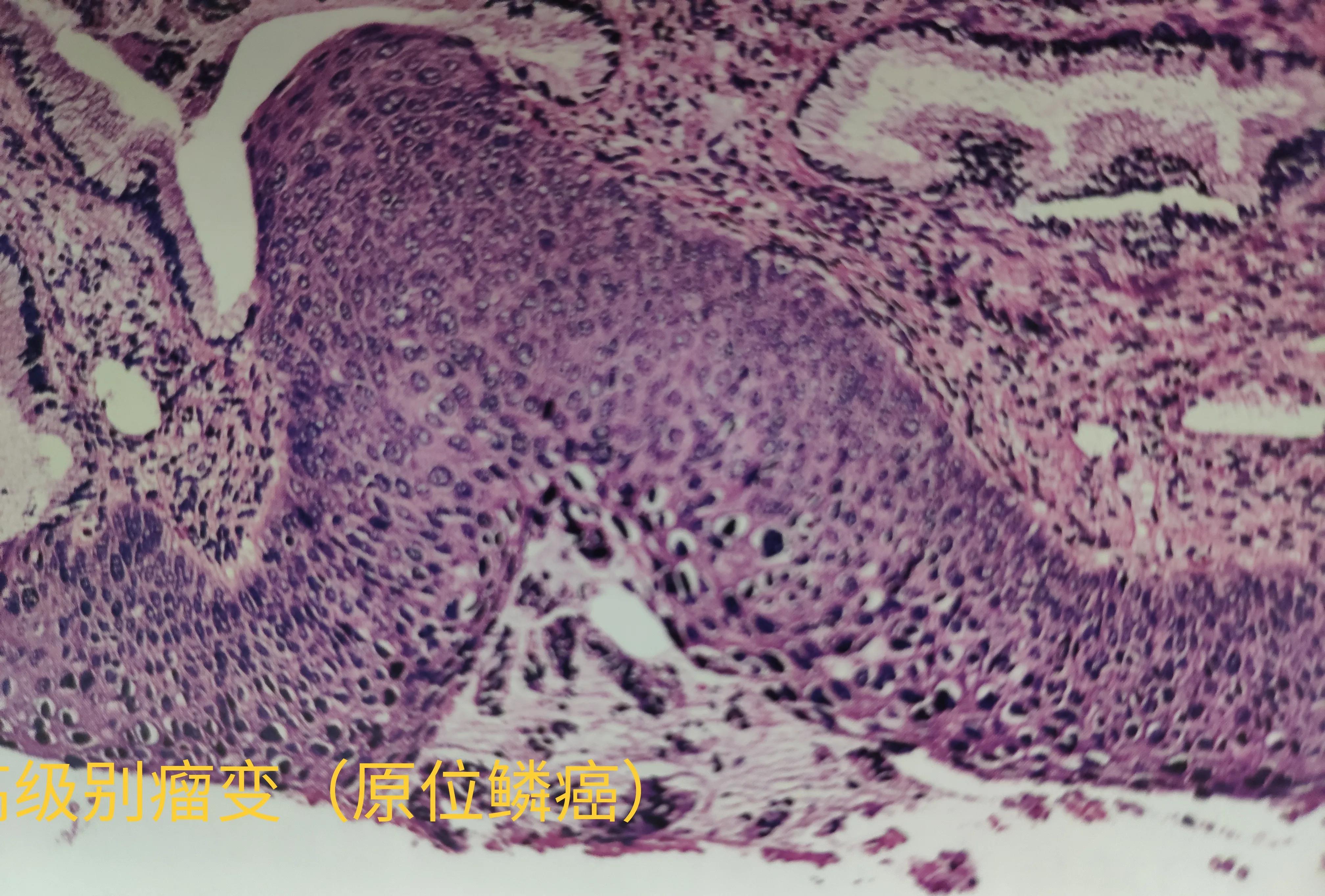 什么是原位癌?与浸润癌有何区别?原位癌会转移吗?