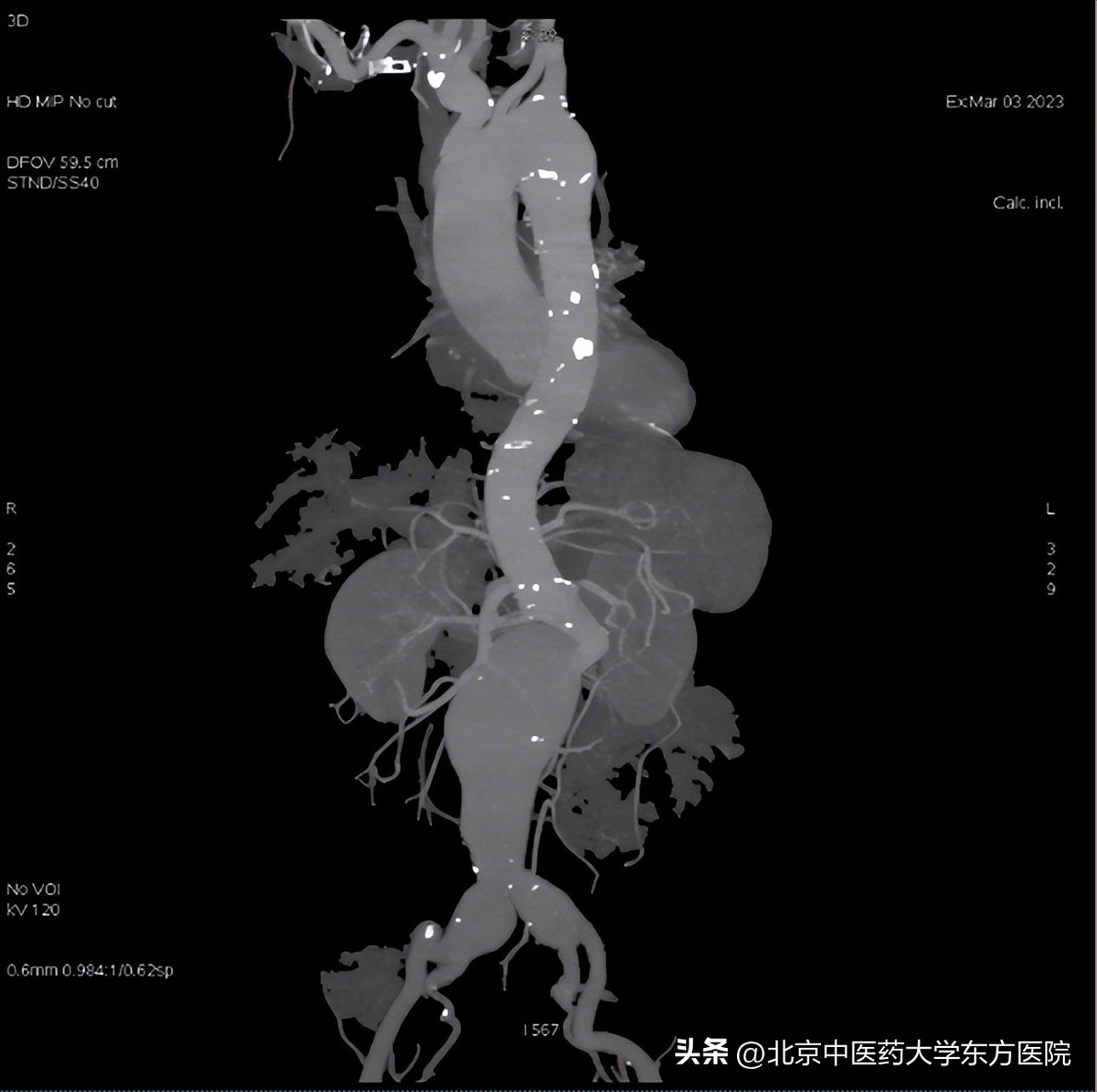 北京中医药大学东方医院成功完成首例保留双侧髂内动脉的巨大腹主动脉瘤合并双侧髂动脉瘤腔内隔绝术！